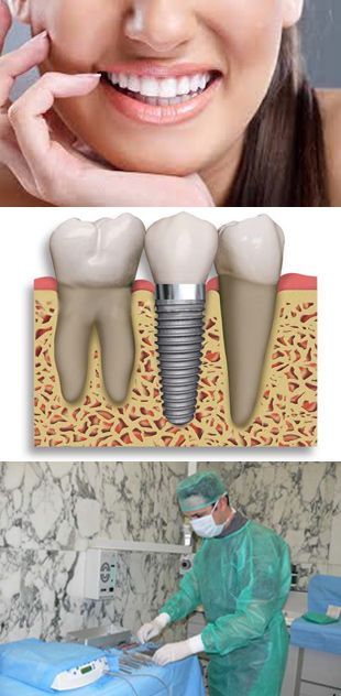 Clínica Dental Txurdinaga implantes